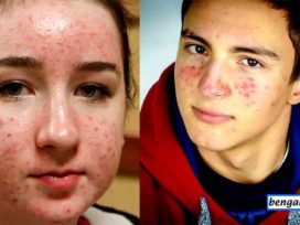 Reason of Acne or Pimple and Treatment